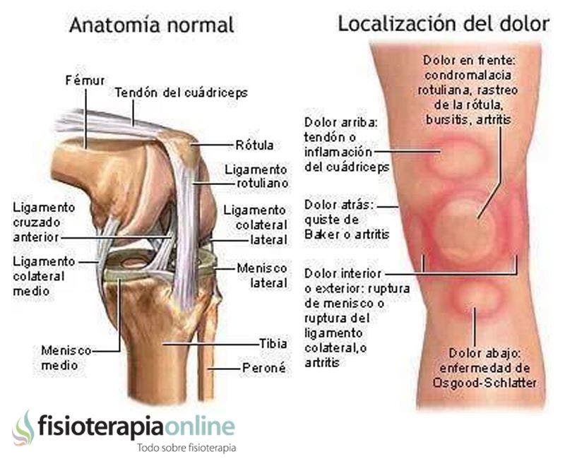 Los patrones del dolor de rodilla o gonalgia y las lesiones mas comunes Fisioterapia Online