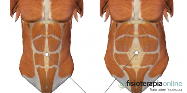 Embarazo: diástasis de los músculos rectos. Generalidades, prevención y tratamiento.