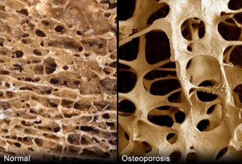 Qué es la Osteoporosis y como pueden ayudarte el Yoga y el pilates para tener huesos fuertes.