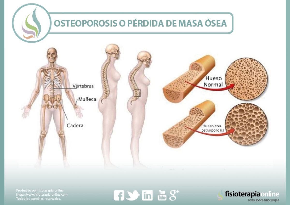Плотный увеличиваться. Остеопороз. Остеопороз костей. Кость при остеопорозе. Остеопороз картинки.