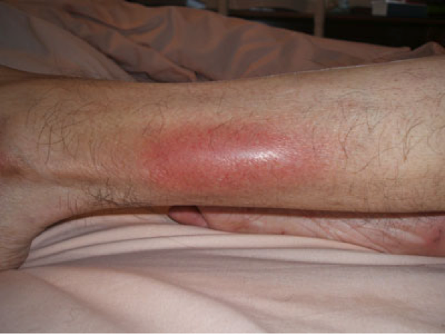 trombosis venosa en brazo sintomas