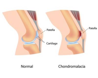 Condromalacia rotuliana. ¿Qué es? Causas Síntomas y tratamiento fisioterapéutico