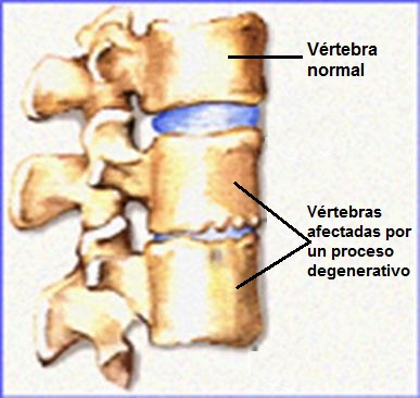 quiste sinovial articulacion facetaria