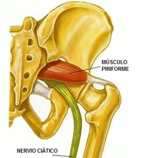 que es la ciatica en el cuerpo humano