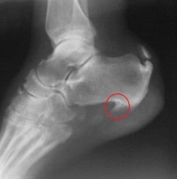espolón calcaneo fascitis plantar tratamiento dolor pie