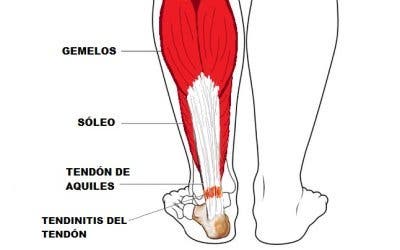 tendinitis de aquiles o aquilea