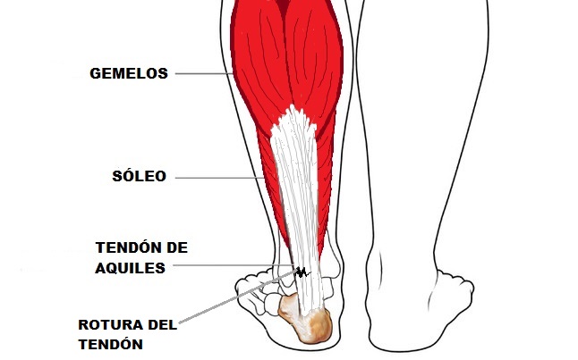 rotura del tend'on de aquiles