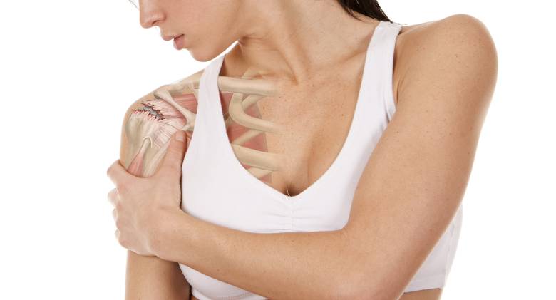 Lesión de hombro: Tendinitis del supraespinoso. ¿Qué es? Causas, ejercicios y tratamiento
