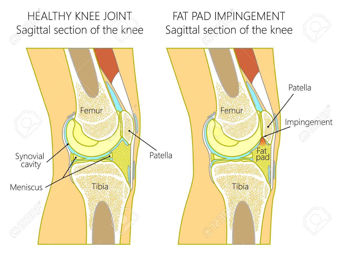 tratamentul artrozei și medicamentelor pentru artrită tratament cu laser pentru artroza genunchiului