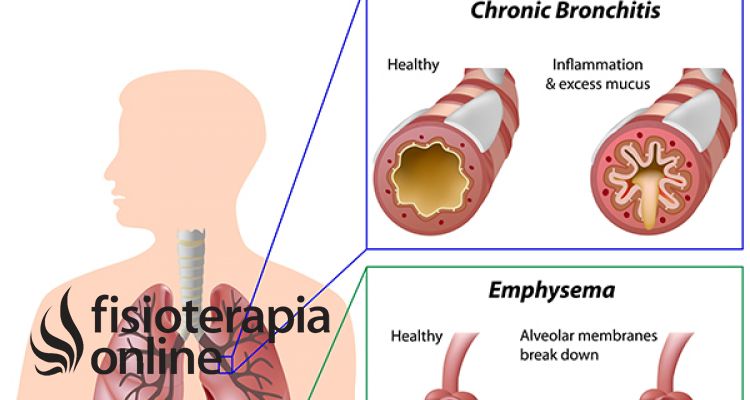 hoja túnel oficial Enfermedad pulmonar obstructiva cronica o EPOC ¿Qué es? | FisioOnline