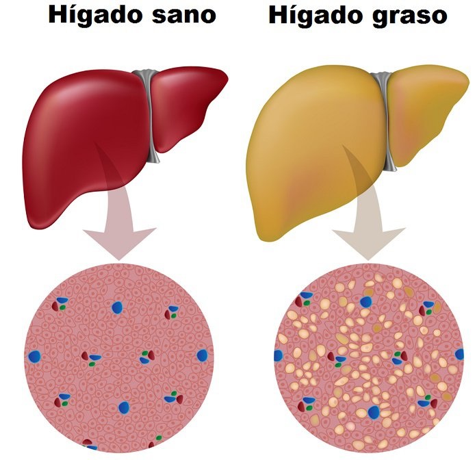 diabetes e hígado graso