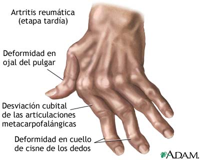 Ejercicios Beneficiosos En La Artritis Reumatoide De Mano Fisioonline