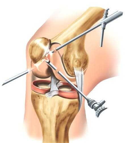 Cirugía de condromalacia rotuliana, artroscopia de rodilla 