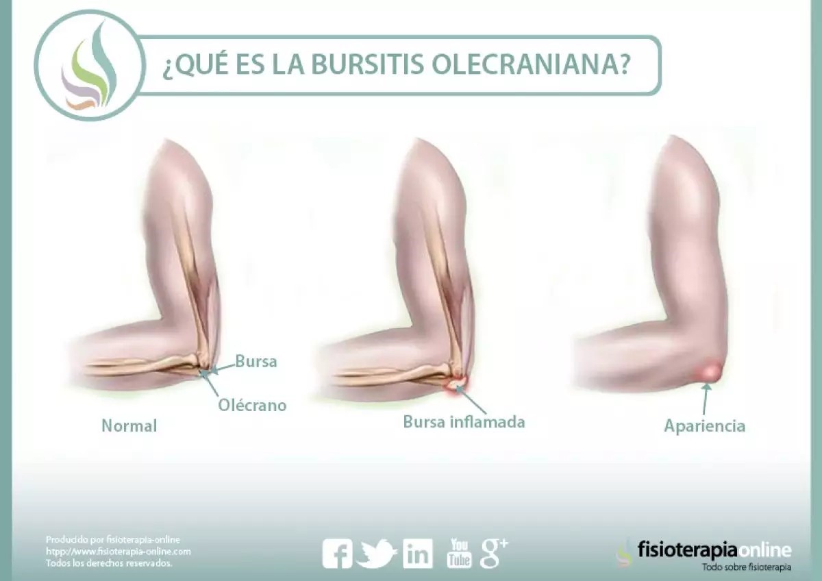 bursitis