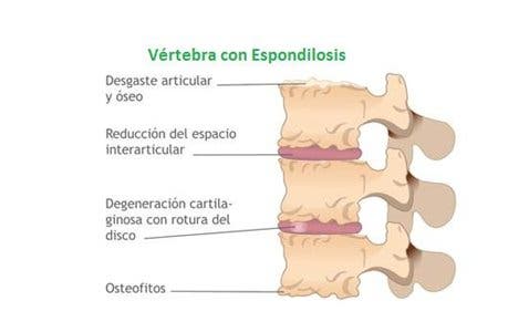 Espondilosis lumbar tratamiento