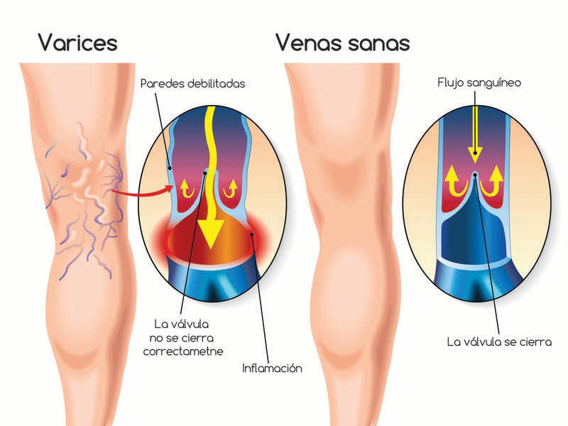 Mala circulación en piernas. Aprende a combatirla. Centro de