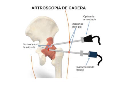 Cirugía de pinzamiento fémoroacetabular 