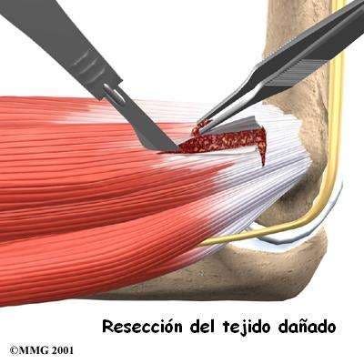 cirugía de epicondilitis 