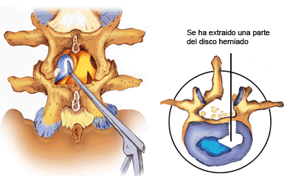 Cirugía de hernia discal lumbar 
