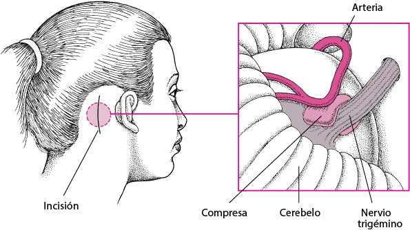 Cirugía de la neuralgia de Arnold 