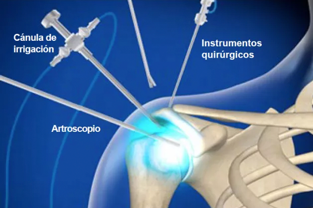 Cirugía de Manguito Rotador 
