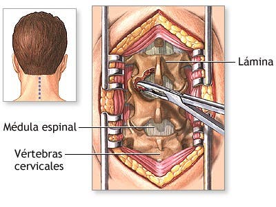 Cirugía de hernia discal cervical 