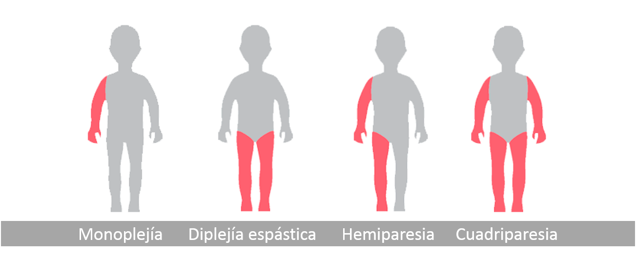 Clasificacion de la paralisis cerebral