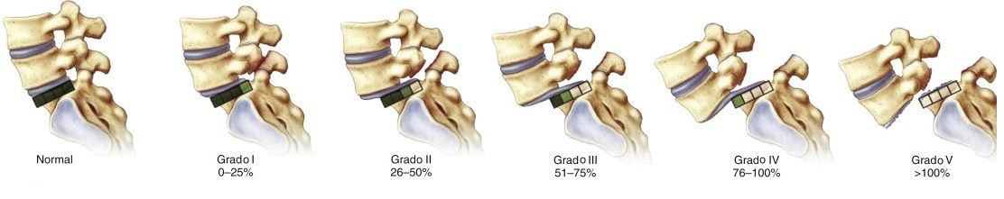 Clasificación de la espondilolistesis