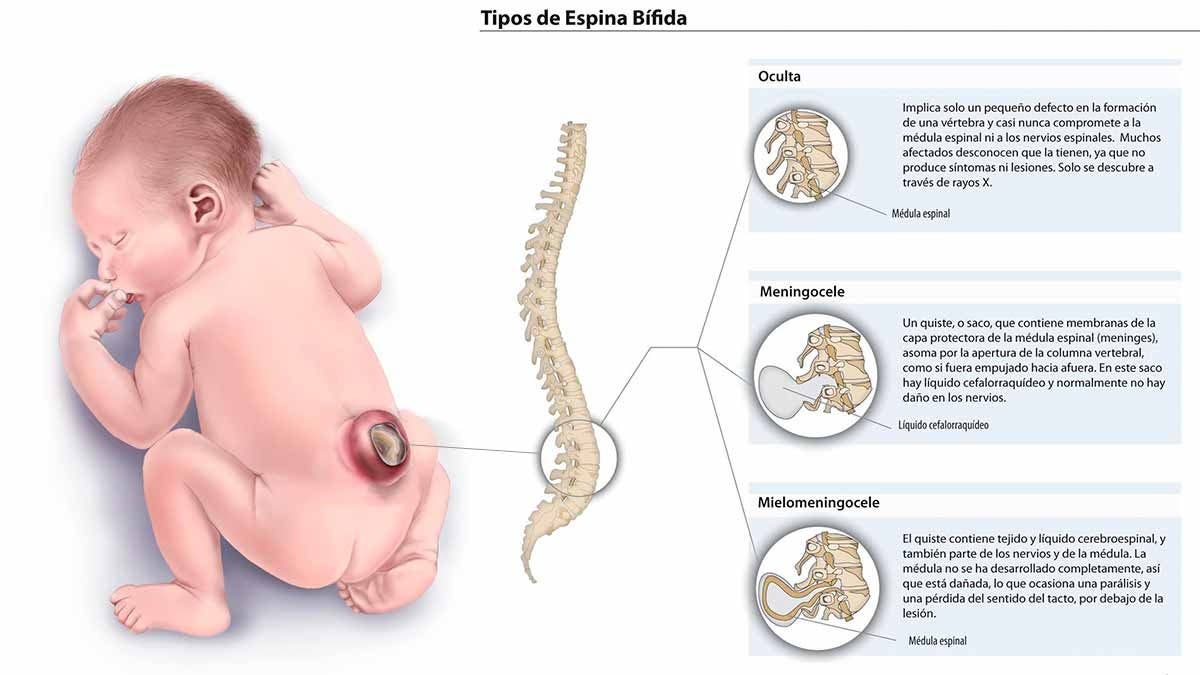 Tipos de espina bífida