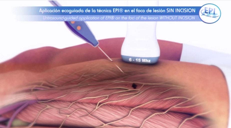 Cómo funciona y cuáles son los efectos de la EPI