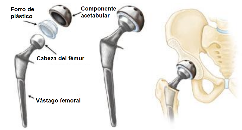 componente de la prótesis de cadera