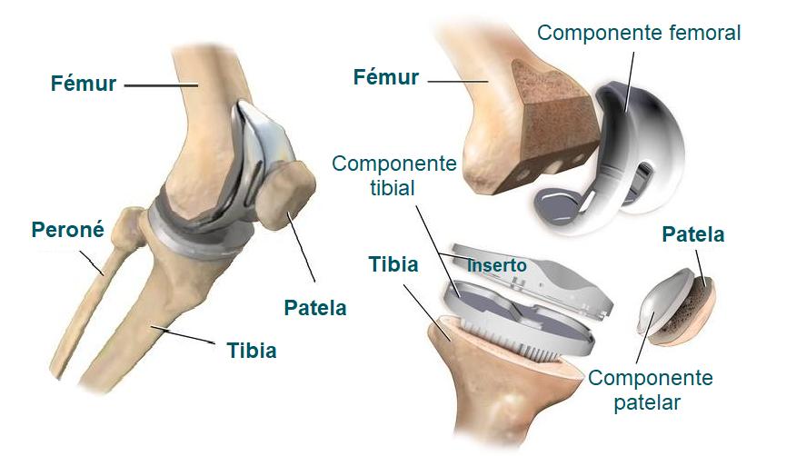 Componente de la prótesis de rodilla