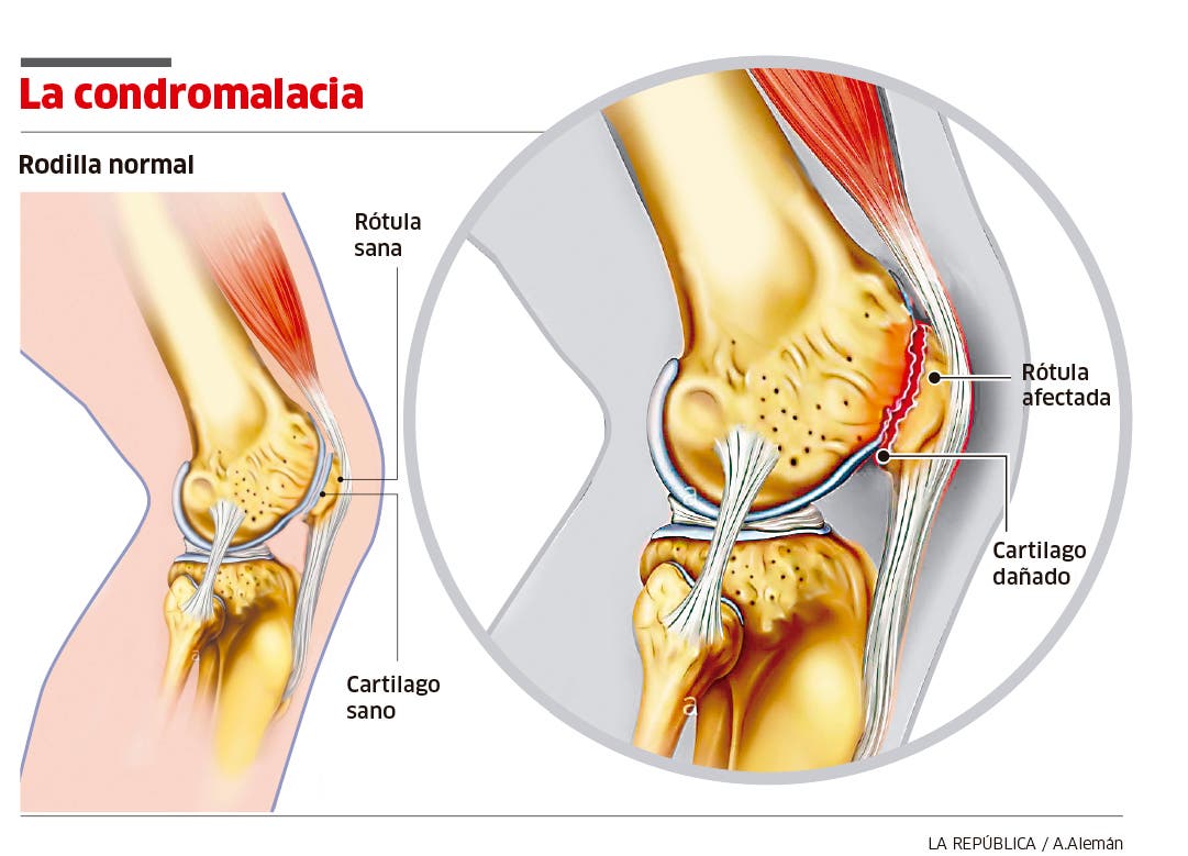 condromalacia rotuliana