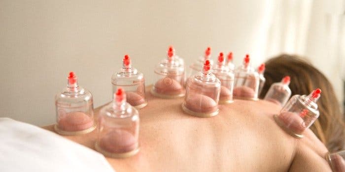 Cupping Therapy