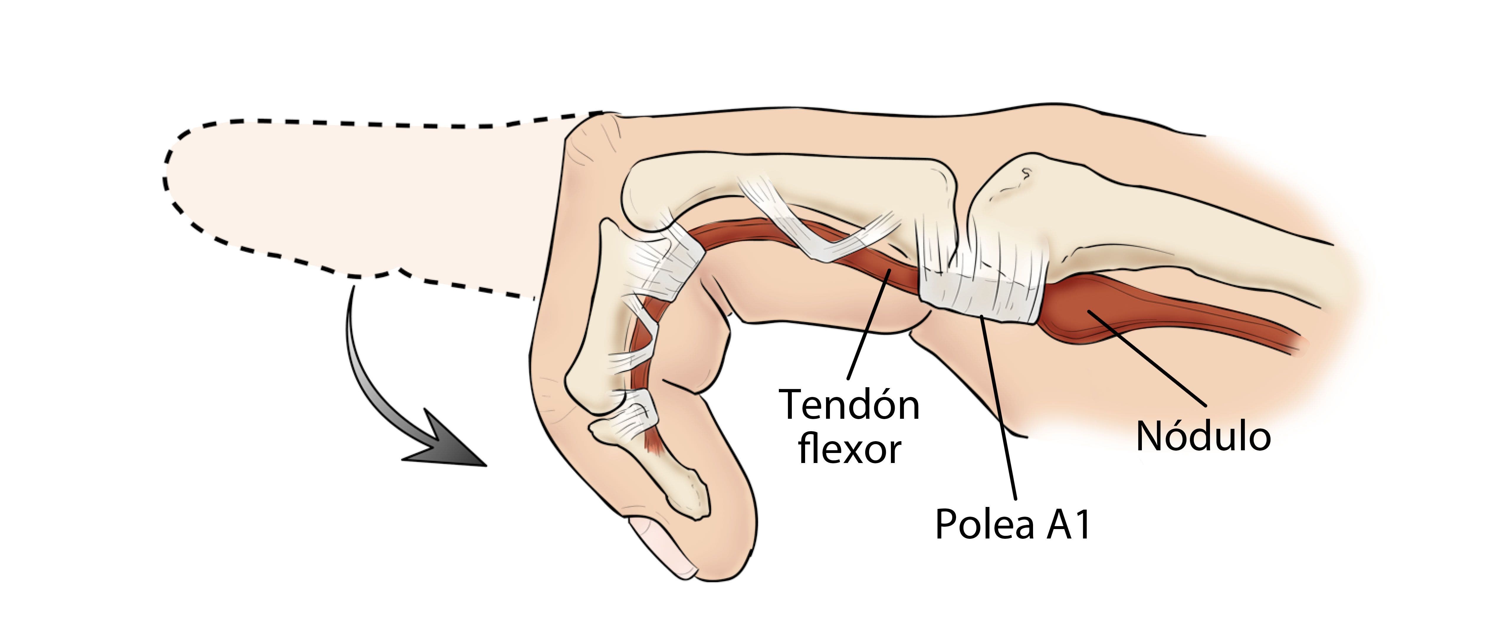 Anatomía del dedo en gatillo o resorte