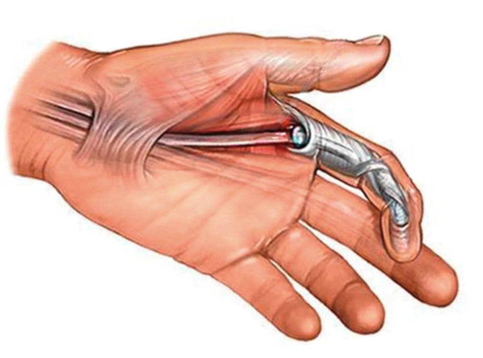 Cirugía del dedo en gatillo o resorte 