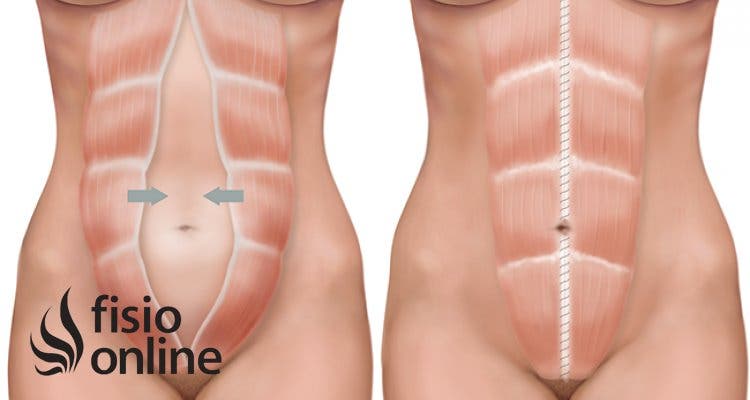 diástasis abdominal