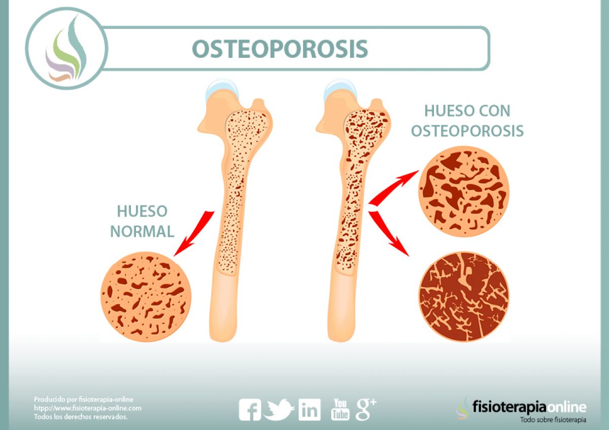 Diferencia entre hueso normal y con osteoporosis