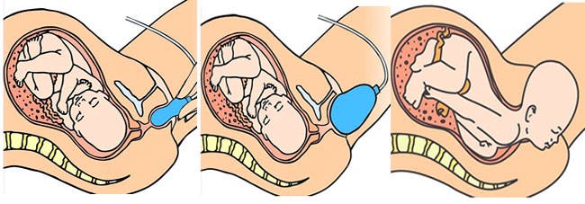 Epi-No en el embarazo y el masaje perineal 