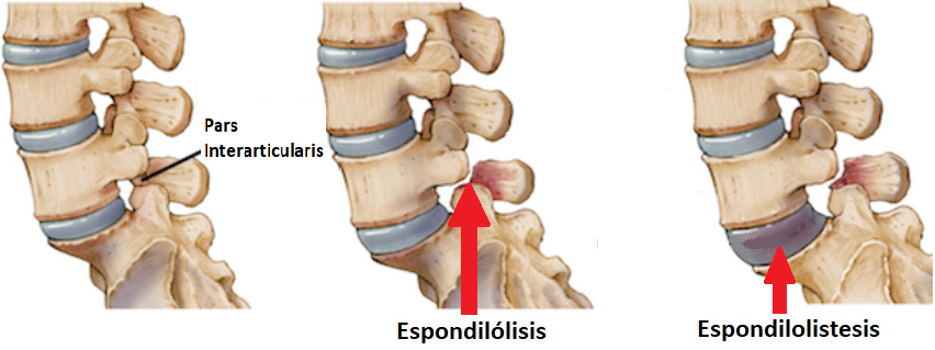 Espondilolisis – Espondilolistesis