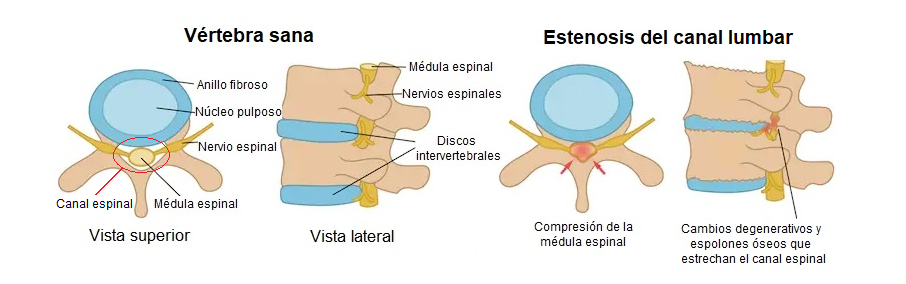 estenosis del canal lumbar