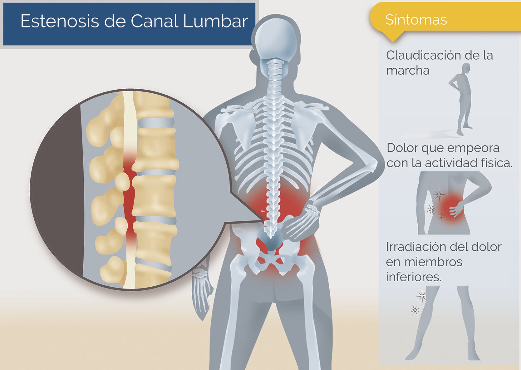 Estenosis del canal lumbar síntomas