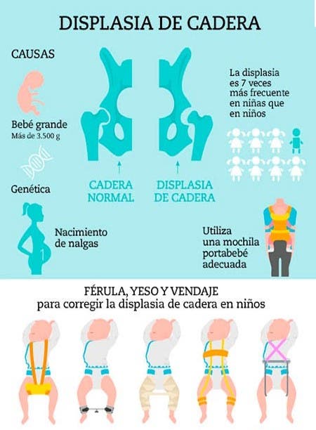displasia de cadera