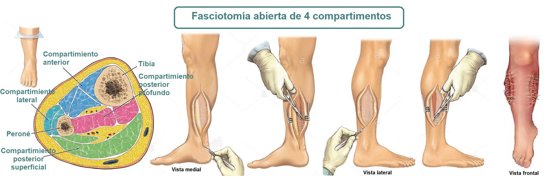 Fasciotomia