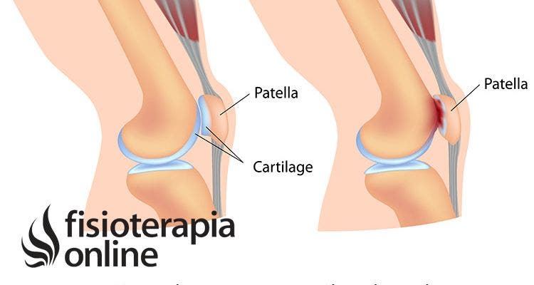 De rodilla fisioterapia bursitis