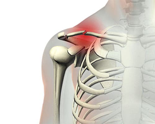 Fractura de clavícula
