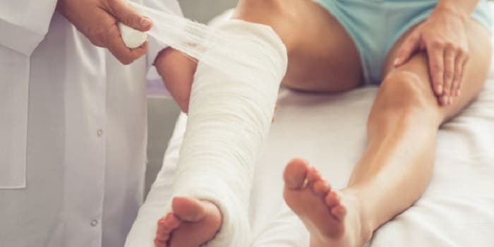 FRACTURA de TIBIA y PERONÉ: Tratamiento desde la fase de INMOVILIZACIÓN