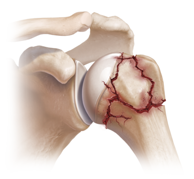 fractura proximal de húmero