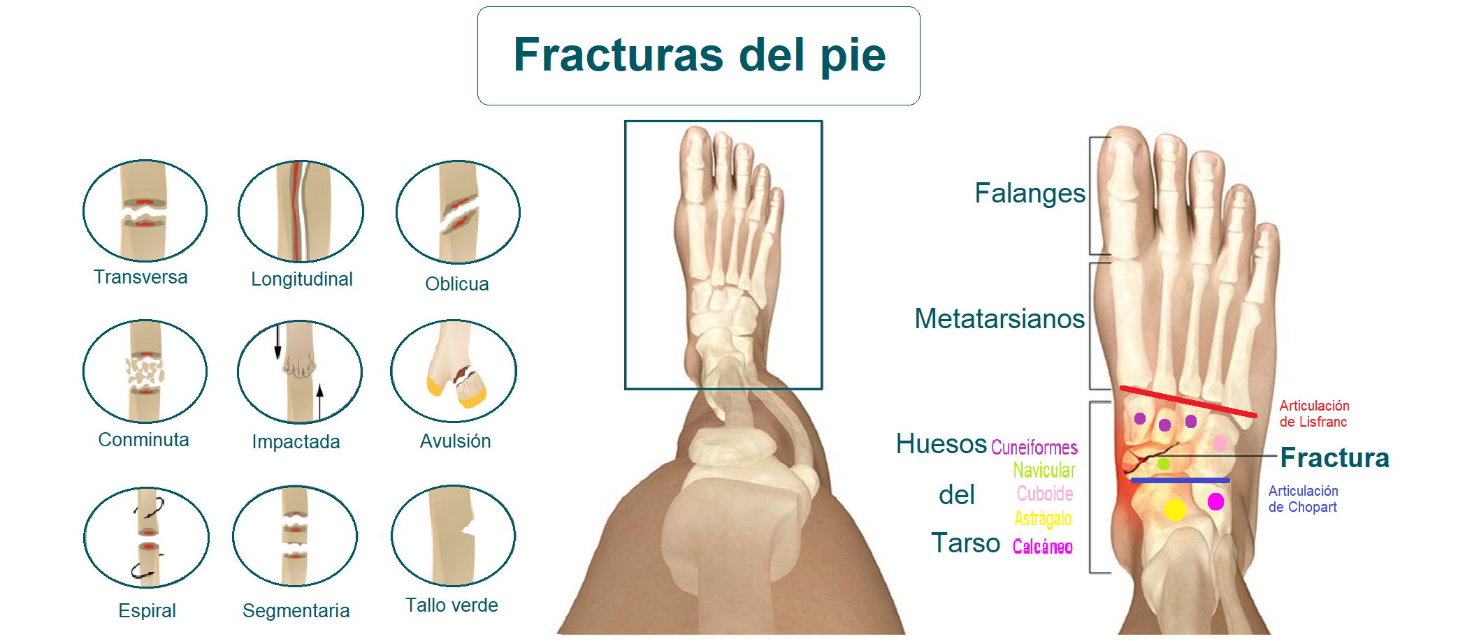 Fracturas del pie Fracturas del pie