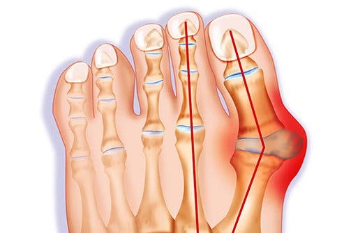 Hallux vagus o juanete